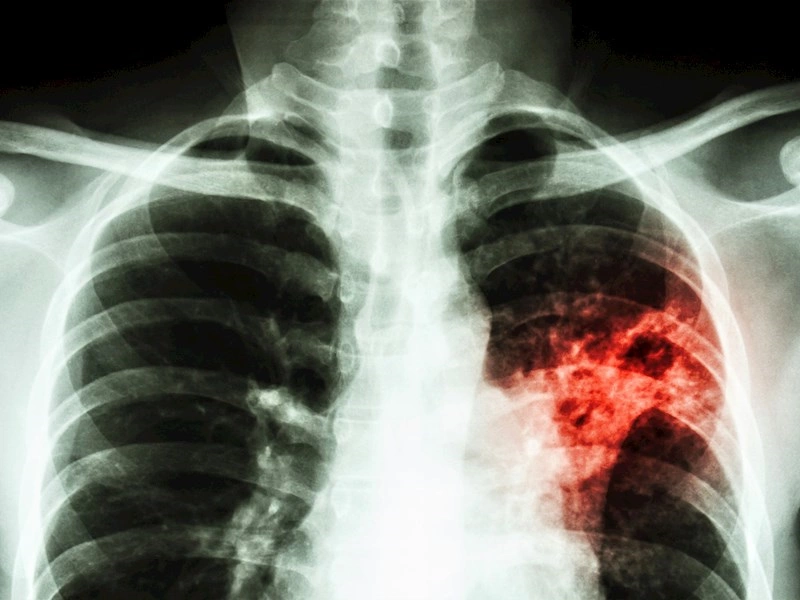 Nyt partnerskab mellem Statens Serum Institut (SSI) og indisk medicinalkoncern skal styrke kampen mod tuberkulose (TB)