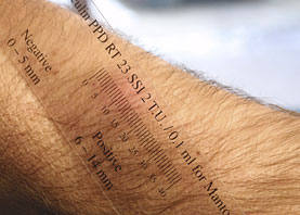 Aflæsning af induration