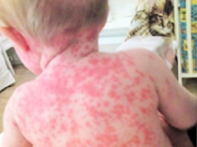 Den bedste beskyttelse mod mæslinger er vaccination med MFR vaccine. Den
 gives normalt i det danske børnevaccinationsprogram ved 15 mdr. og ved 4
 år.